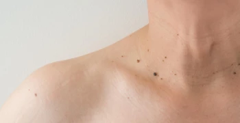 Wart vs. Skin Tag: What's The Difference & How To Treat Them