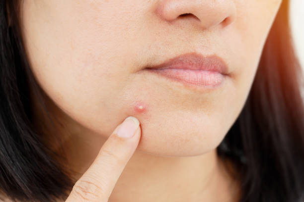 Easy Ways For Treating Pimples Under The Skin