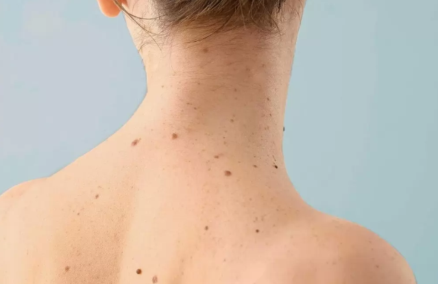 How To Use Tea Tree Oil For Skin Tags: A Guide